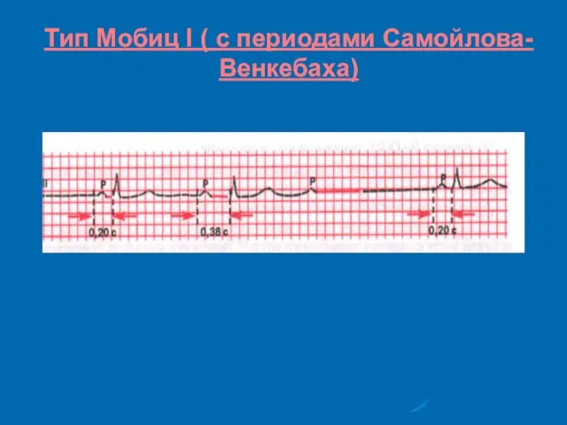 Тип Мобиц I ( с периодами Самойлова-Венкебаха)‏