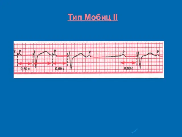 Тип Мобиц II