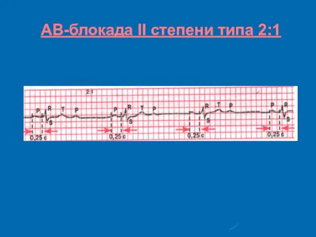 АВ-блокада II степени типа 2:1