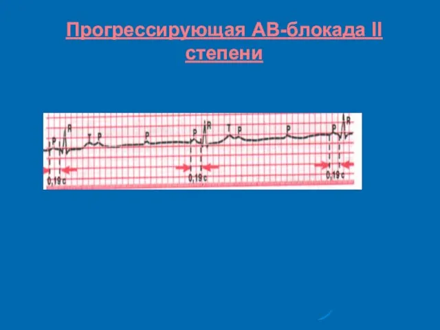 Прогрессирующая АВ-блокада II степени