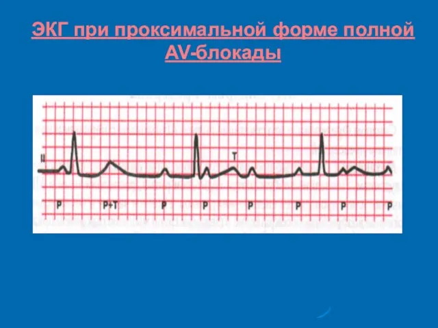 ЭКГ при проксимальной форме полной AV-блокады