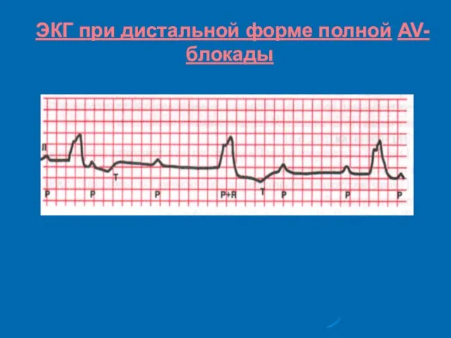 ЭКГ при дистальной форме полной AV-блокады