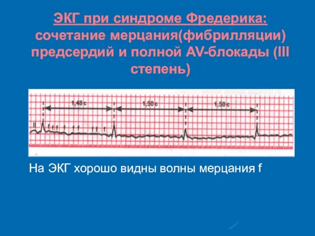 ЭКГ при синдроме Фредерика: сочетание мерцания(фибрилляции) предсердий и полной AV-блокады (III