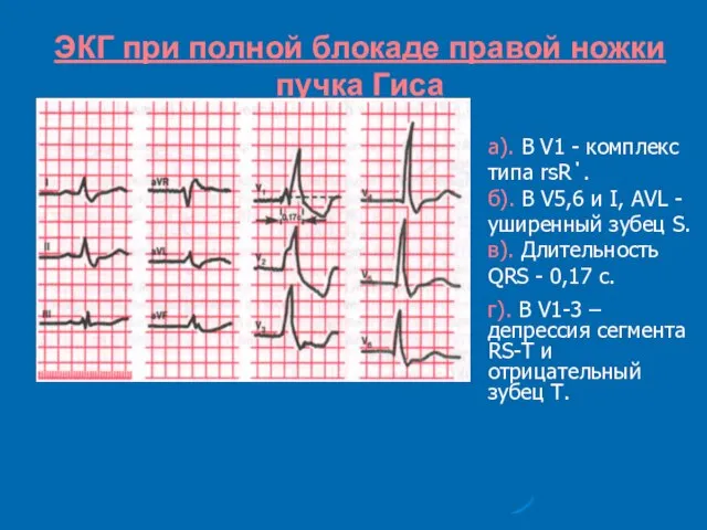 ЭКГ при полной блокаде правой ножки пучка Гиса а). В V1