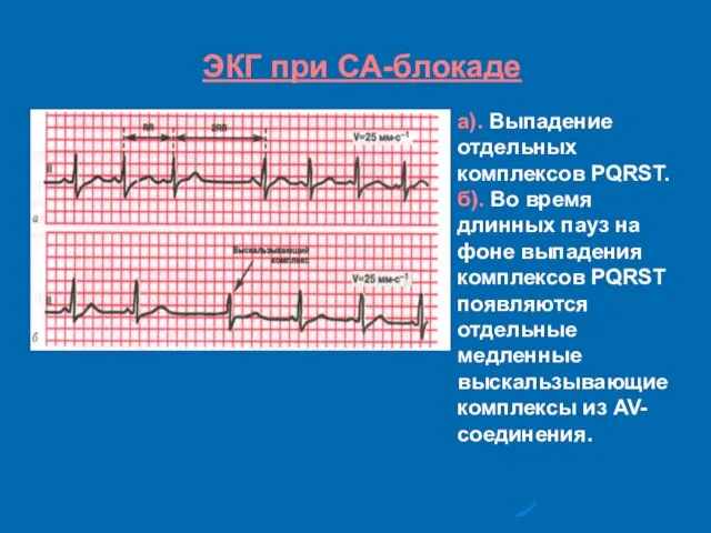 ЭКГ при СА-блокаде а). Выпадение отдельных комплексов PQRST. б). Во время