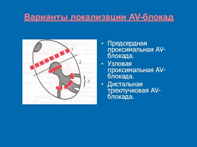 Варианты локализации AV-блокад Предсердная проксимальная AV-блокада. Узловая проксимальная AV-блокада. Дистальная трехпучковая AV-блокада.