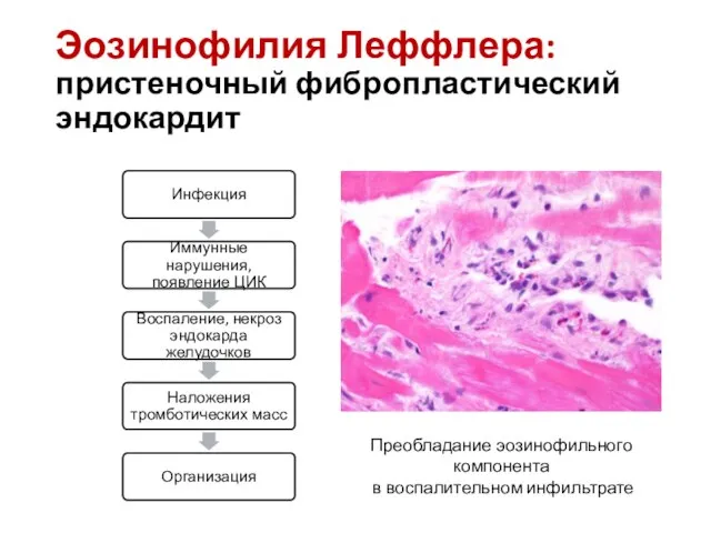 Эозинофилия Леффлера: пристеночный фибропластический эндокардит Преобладание эозинофильного компонента в воспалительном инфильтрате