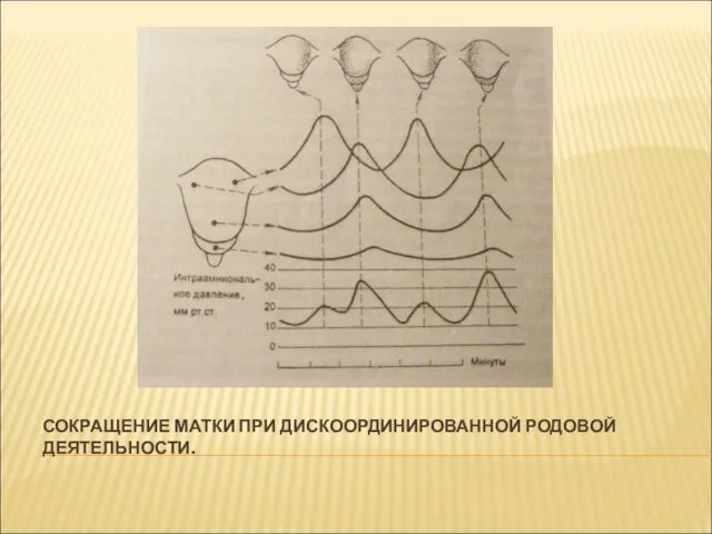 СОКРАЩЕНИЕ МАТКИ ПРИ ДИСКООРДИНИРОВАННОЙ РОДОВОЙ ДЕЯТЕЛЬНОСТИ.