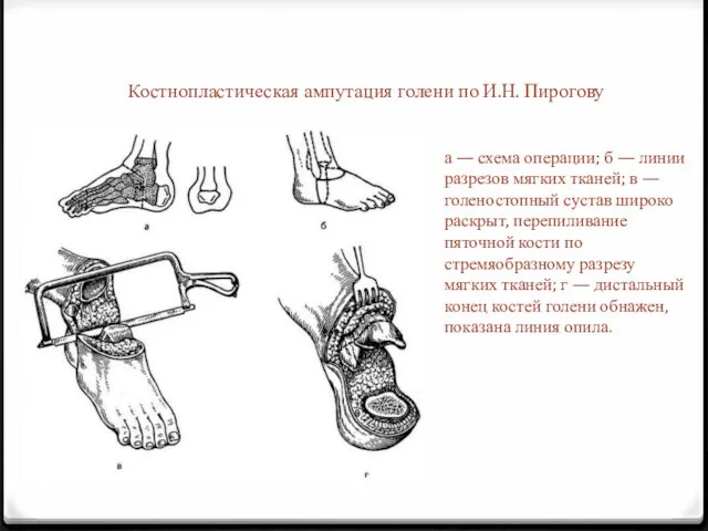 Костнопластическая ампутация голени по И.Н. Пирогову а — схема операции; б