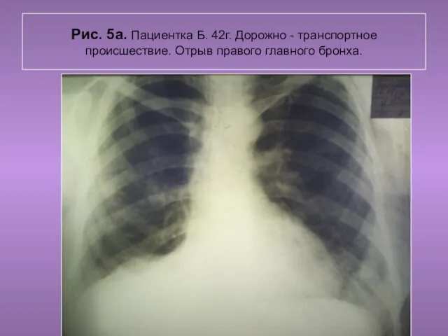 Н.С. Воротынцева. С.С. Гольев Рентгенопульмология Рис. 5а. Пациентка Б. 42г. Дорожно