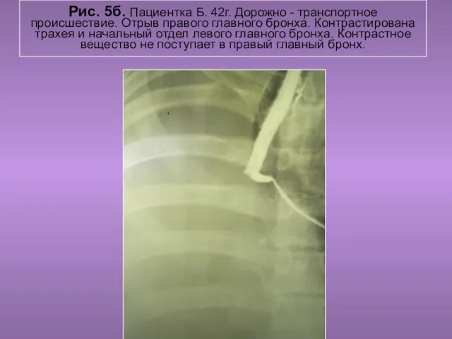 Н.С. Воротынцева. С.С. Гольев Рентгенопульмология Рис. 5б. Пациентка Б. 42г. Дорожно