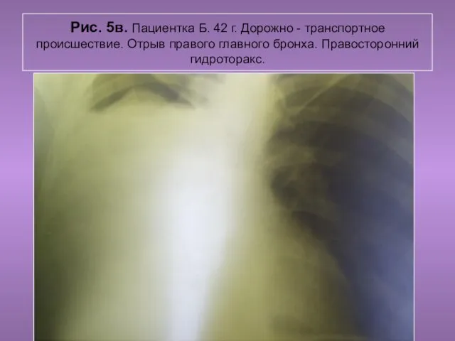 Н.С. Воротынцева. С.С. Гольев Рентгенопульмология Рис. 5в. Пациентка Б. 42 г.