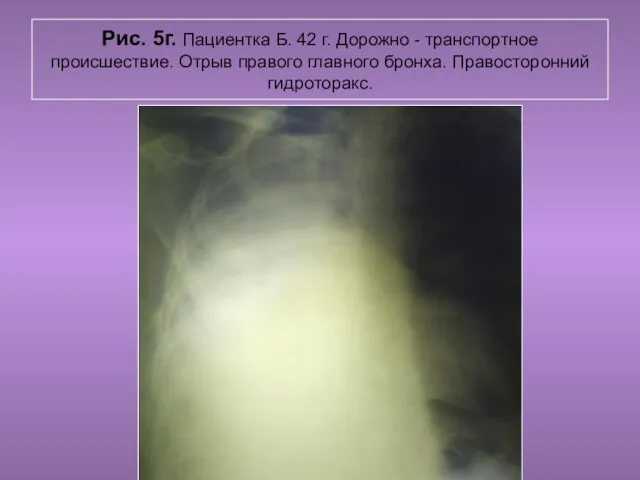 Н.С. Воротынцева. С.С. Гольев Рентгенопульмология Рис. 5г. Пациентка Б. 42 г.