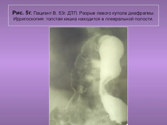 Н.С. Воротынцева. С.С. Гольев Рентгенопульмология Рис. 5г. Пациент В. 53г. ДТП.