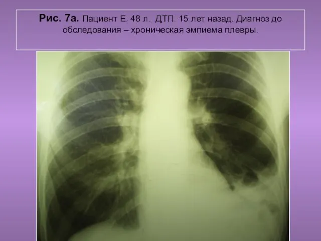 Н.С. Воротынцева. С.С. Гольев Рентгенопульмология Рис. 7а. Пациент Е. 48 л.