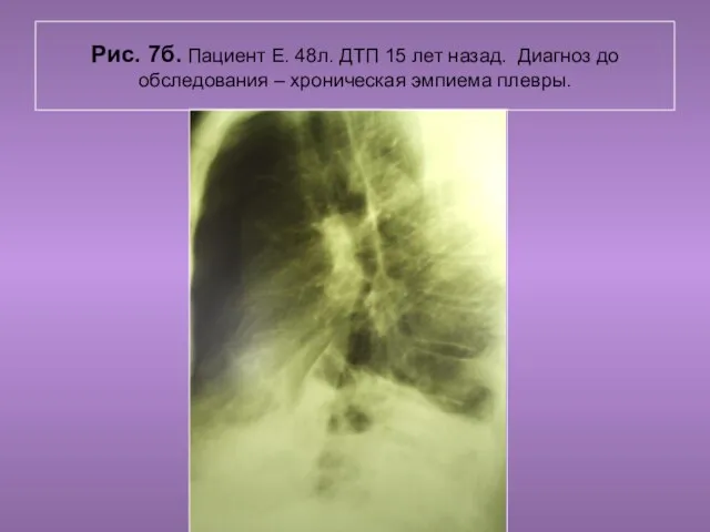 Н.С. Воротынцева. С.С. Гольев Рентгенопульмология Рис. 7б. Пациент Е. 48л. ДТП