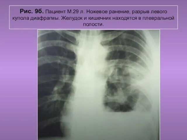 Н.С. Воротынцева. С.С. Гольев Рентгенопульмология Рис. 9б. Пациент М.29 л. Ножевое