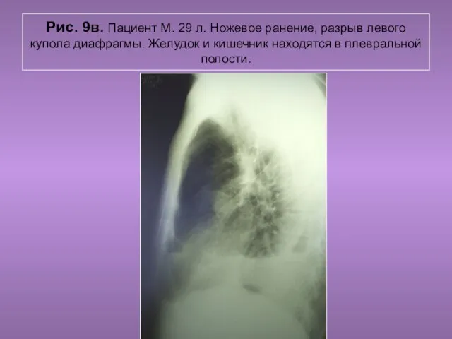 Н.С. Воротынцева. С.С. Гольев Рентгенопульмология Рис. 9в. Пациент М. 29 л.