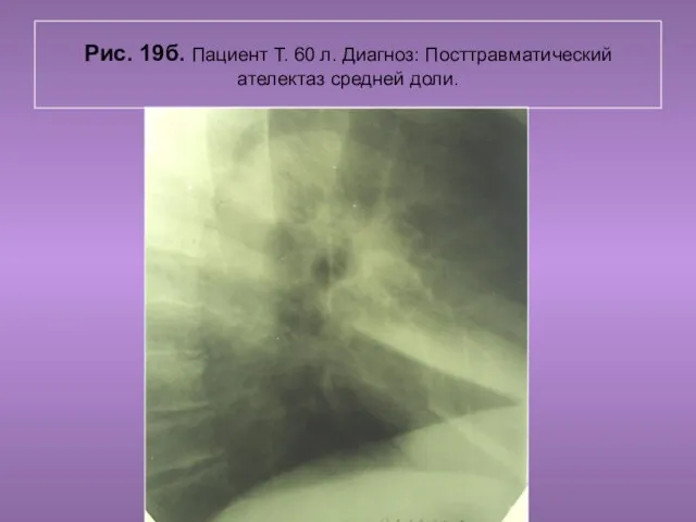 Н.С. Воротынцева. С.С. Гольев Рентгенопульмология Рис. 19б. Пациент Т. 60 л. Диагноз: Посттравматический ателектаз средней доли.