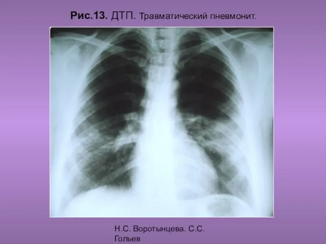 Н.С. Воротынцева. С.С. Гольев Рентгенопульмология Рис.13. ДТП. Травматический пневмонит.