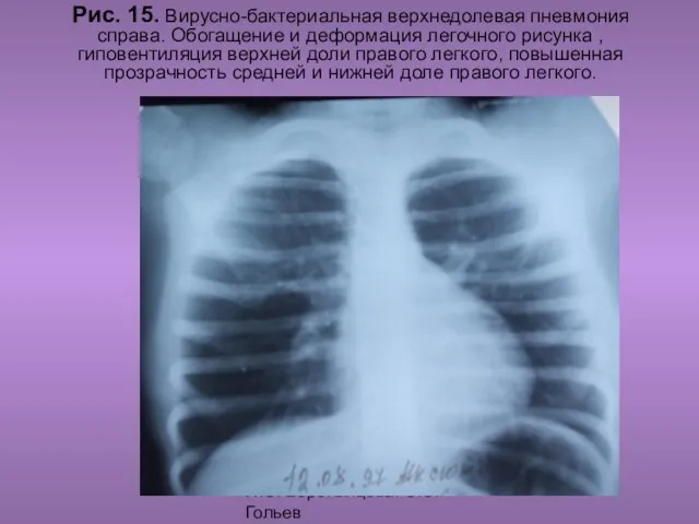 Н.С. Воротынцева. С.С. Гольев Рентгенопульмология Рис. 15. Вирусно-бактериальная верхнедолевая пневмония справа.