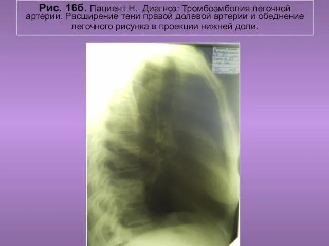 Н.С. Воротынцева. С.С. Гольев Рентгенопульмология Рис. 16б. Пациент Н. Диагноз: Тромбоэмболия