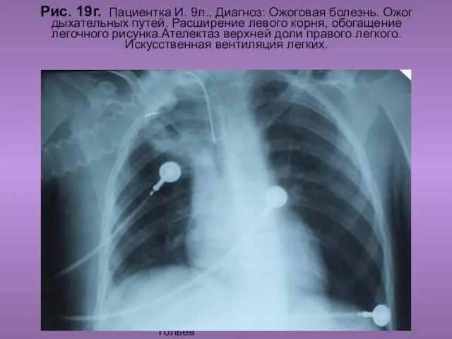 Н.С. Воротынцева. С.С. Гольев Рентгенопульмология Рис. 19г. Пациентка И. 9л., Диагноз: