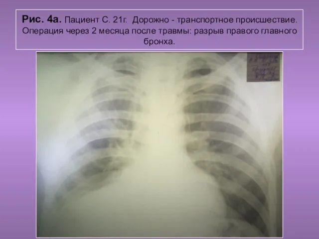 Н.С. Воротынцева. С.С. Гольев Рентгенопульмология Рис. 4а. Пациент С. 21г. Дорожно