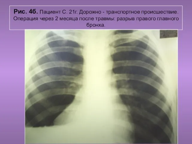 Н.С. Воротынцева. С.С. Гольев Рентгенопульмология Рис. 4б. Пациент С. 21г. Дорожно