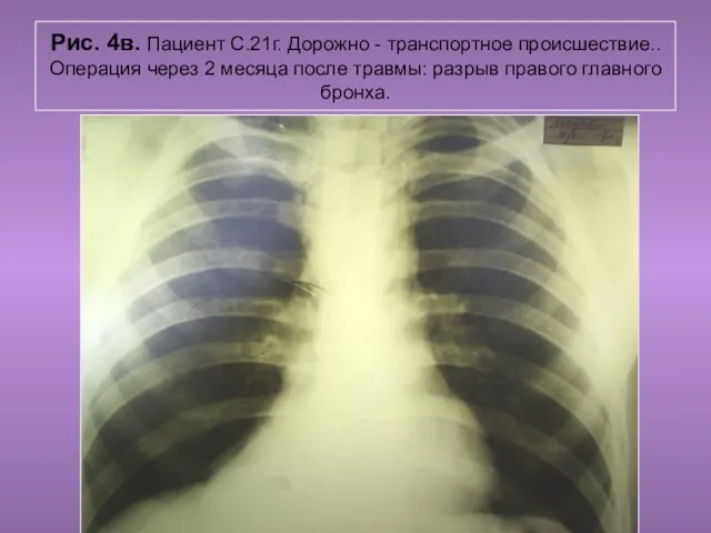 Н.С. Воротынцева. С.С. Гольев Рентгенопульмология Рис. 4в. Пациент С.21г. Дорожно -