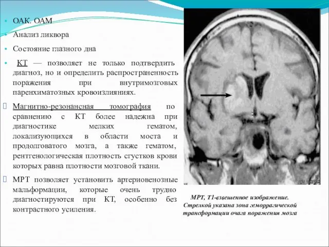 МРТ, Т1-взвешенное изображение. Стрелкой указана зона геморрагической трансформации очага поражения мозга