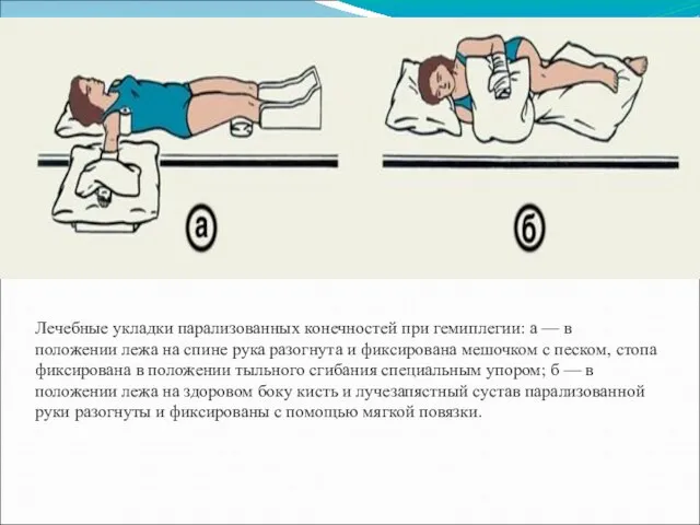 Лечебные укладки парализованных конечностей при гемиплегии: а — в положении лежа