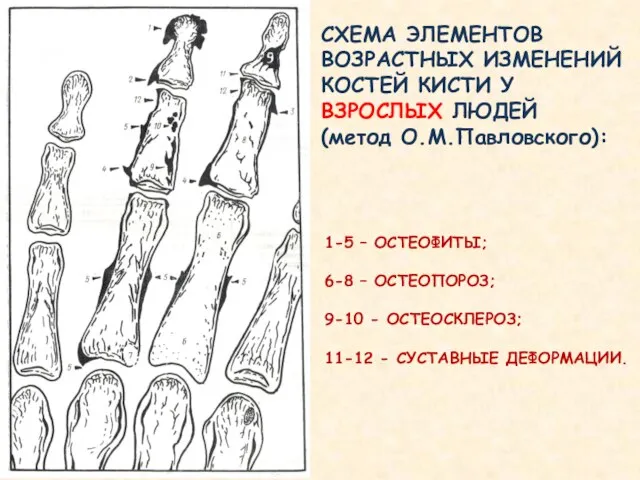 СХЕМА ЭЛЕМЕНТОВ ВОЗРАСТНЫХ ИЗМЕНЕНИЙ КОСТЕЙ КИСТИ У ВЗРОСЛЫХ ЛЮДЕЙ (метод О.М.Павловского):