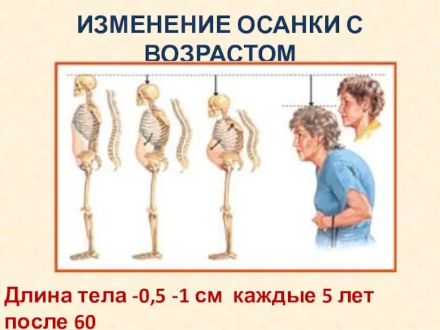 ИЗМЕНЕНИЕ ОСАНКИ С ВОЗРАСТОМ Длина тела -0,5 -1 см каждые 5 лет после 60