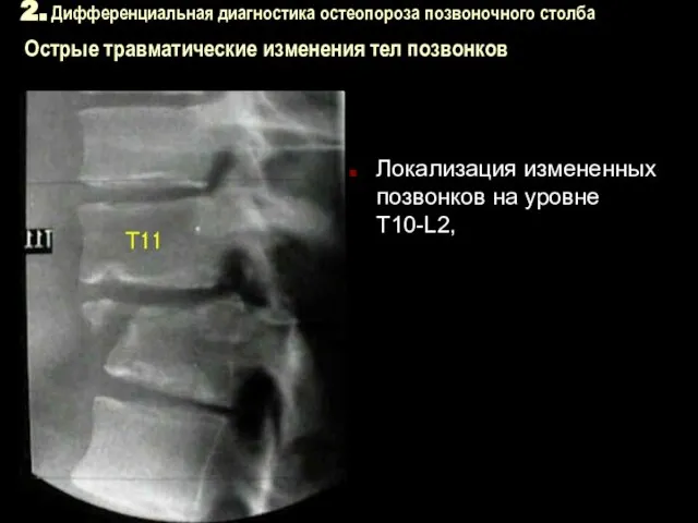 2. Дифференциальная диагностика остеопороза позвоночного столба Острые травматические изменения тел позвонков