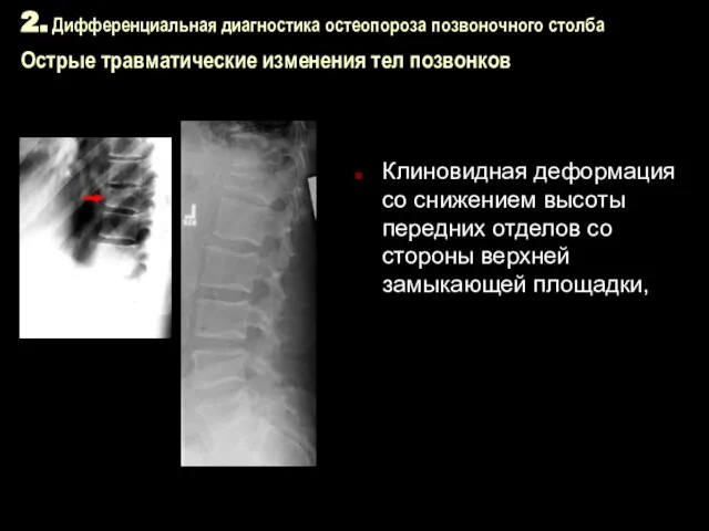 2. Дифференциальная диагностика остеопороза позвоночного столба Острые травматические изменения тел позвонков