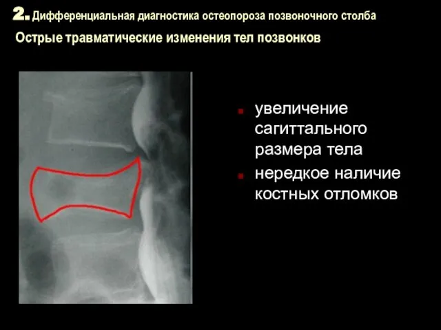 2. Дифференциальная диагностика остеопороза позвоночного столба Острые травматические изменения тел позвонков