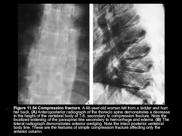 Figure 11.54 Compression fracture. A 48-year-old woman fell from a ladder
