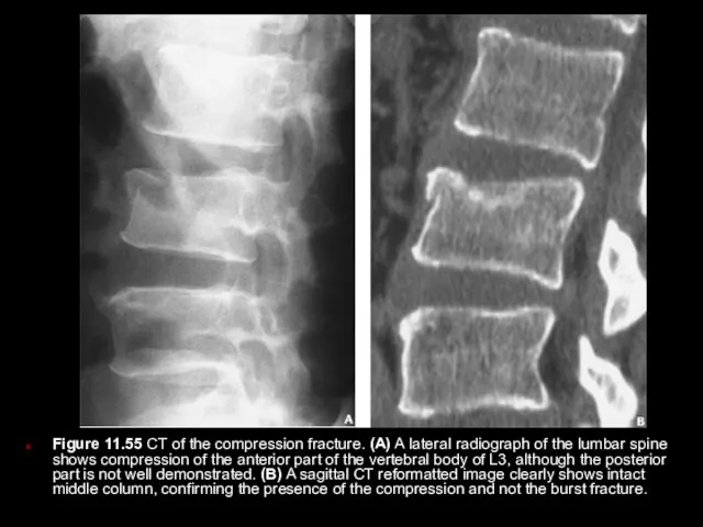 Figure 11.55 CT of the compression fracture. (A) A lateral radiograph