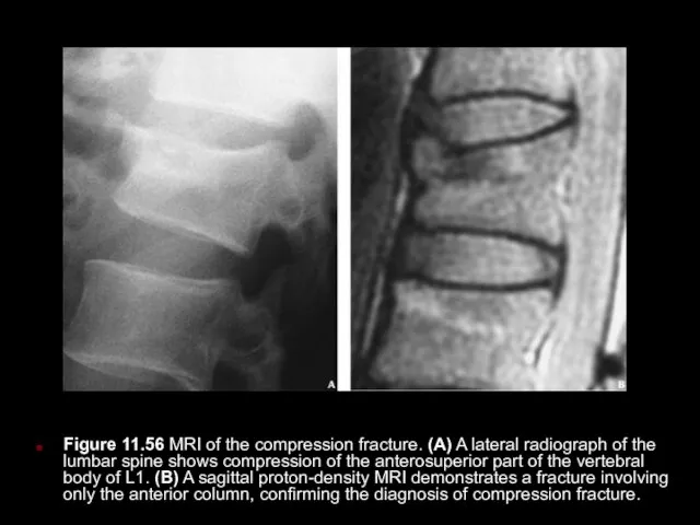 Figure 11.56 MRI of the compression fracture. (A) A lateral radiograph