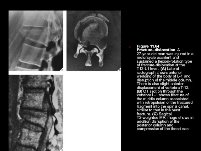 Figure 11.64 Fracture–dislocation. A 27-year-old man was injured in a motorcycle