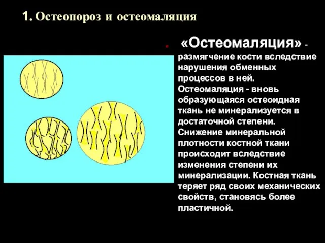 1. Остеопороз и остеомаляция «Остеомаляция» - размягчение кости вследствие нарушения обменных