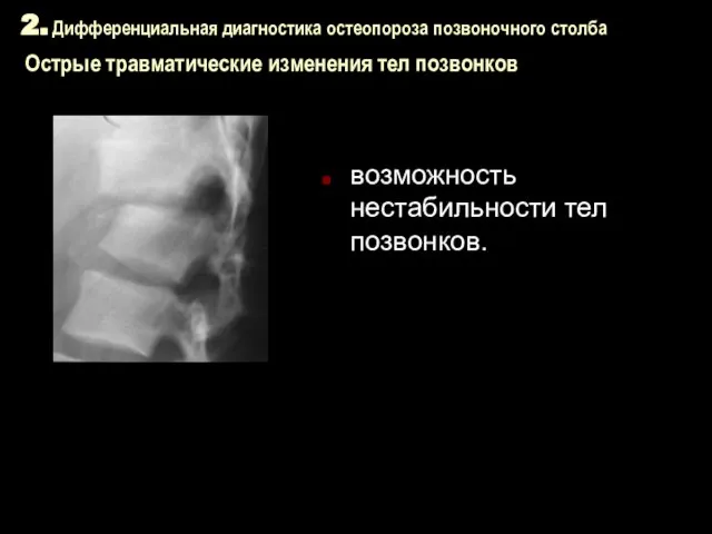 2. Дифференциальная диагностика остеопороза позвоночного столба Острые травматические изменения тел позвонков возможность нестабильности тел позвонков.