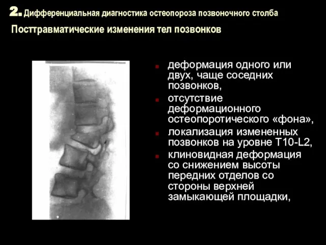 2. Дифференциальная диагностика остеопороза позвоночного столба Посттравматические изменения тел позвонков деформация