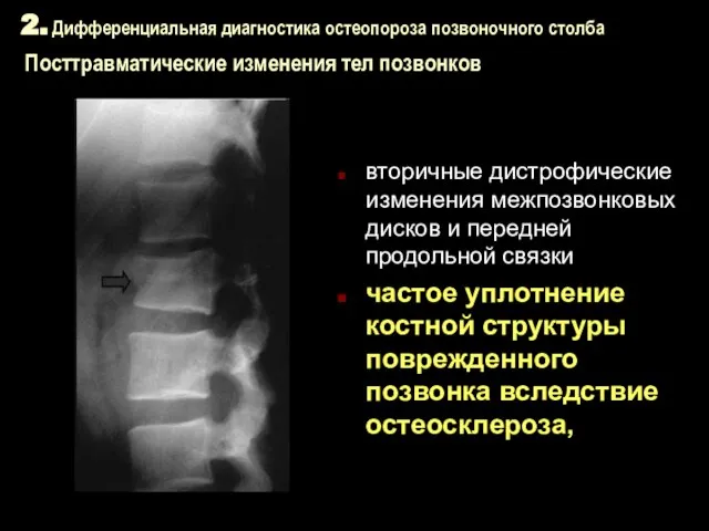 2. Дифференциальная диагностика остеопороза позвоночного столба Посттравматические изменения тел позвонков вторичные