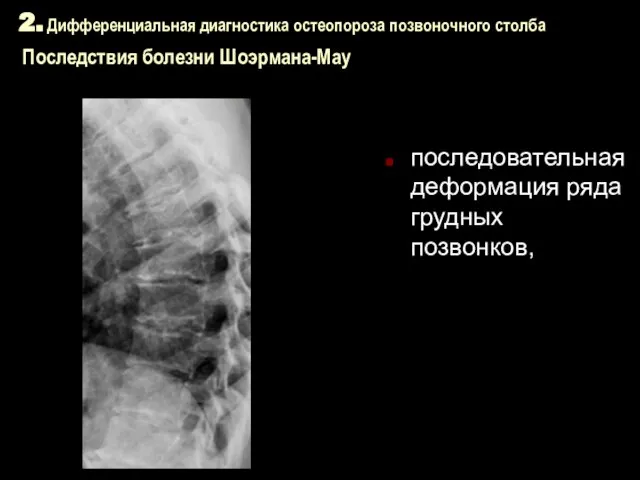 2. Дифференциальная диагностика остеопороза позвоночного столба Последствия болезни Шоэрмана-Мау последовательная деформация ряда грудных позвонков,