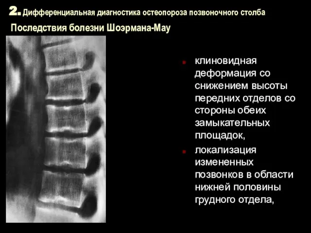 2. Дифференциальная диагностика остеопороза позвоночного столба Последствия болезни Шоэрмана-Мау клиновидная деформация