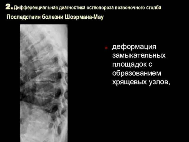 2. Дифференциальная диагностика остеопороза позвоночного столба Последствия болезни Шоэрмана-Мау деформация замыкательных площадок с образованием хрящевых узлов,