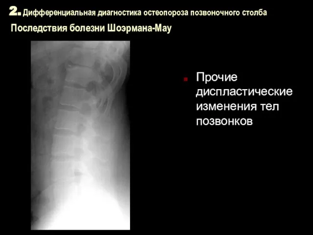 2. Дифференциальная диагностика остеопороза позвоночного столба Последствия болезни Шоэрмана-Мау Прочие диспластические изменения тел позвонков