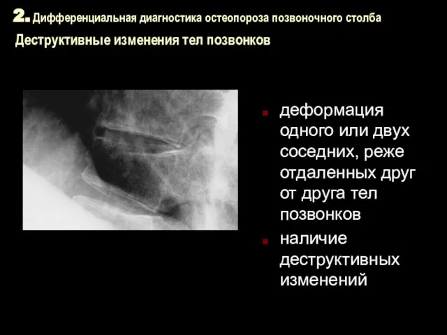 2. Дифференциальная диагностика остеопороза позвоночного столба Деструктивные изменения тел позвонков деформация